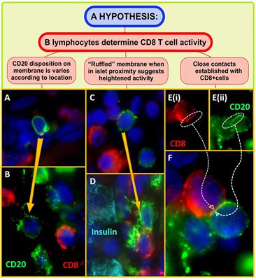 Footprints of Immune Cells in the Pancreas in Type 1 Diabetes; to “B” or Not to “B”: Is That Still the Question?